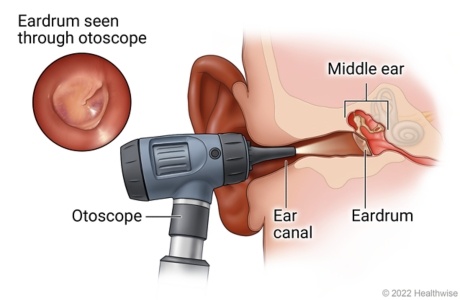 Otoscope Exam